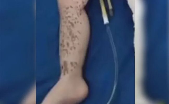 مادة الاسيد الحارقة تسكب على وجه طفلة في أربيل