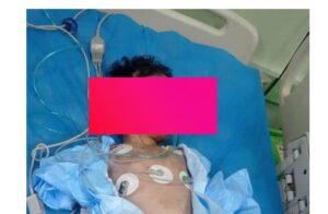 تعذيب الأطفال بالعراق يعزّز رصيده بتكسير عظام الطفل (حيدر) بعد وفاة (موسى)