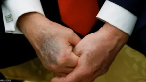 كدمة داكنة جديدة على يد ترامب ومخاوف حول وضعه الصحي